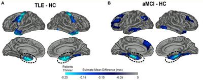 Overlapping and distinct phenotypic profiles in Alzheimer’s disease and late onset epilepsy: a biologically-based approach